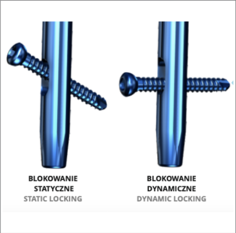 Bloccaggio Distale